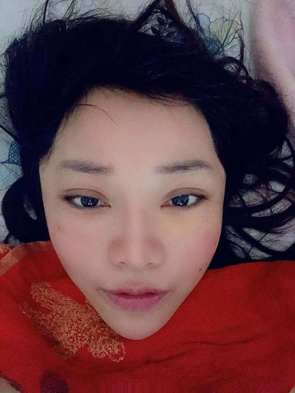 加压面部提升全过程记录，术后30天天我都经历了什么