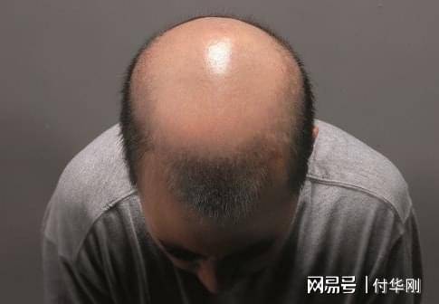 男性到年龄后就会停止脱发