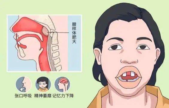 孩子睡觉张嘴越长越丑腺样体肥大一文说清