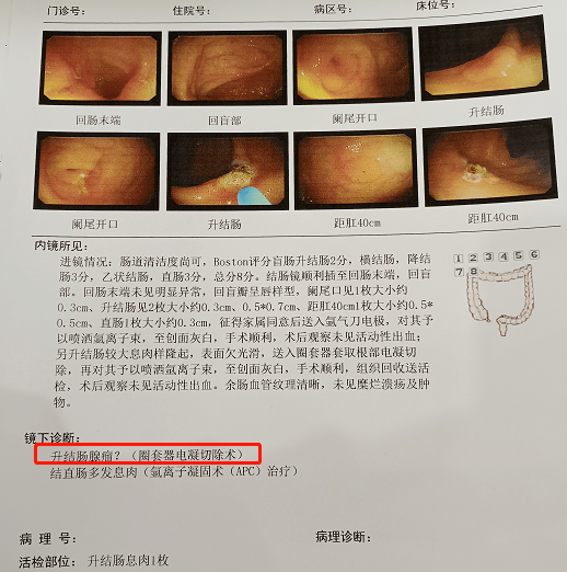 大便不成型才去医院复查,结果发现一个高度怀疑癌变的肠息肉,后病理