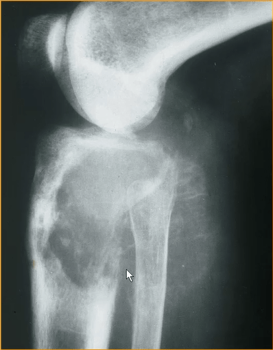 超详细的骨肿瘤与肿瘤样病变影像诊断不要错过
