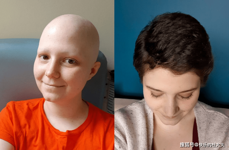 女人化疗头发掉光图片图片