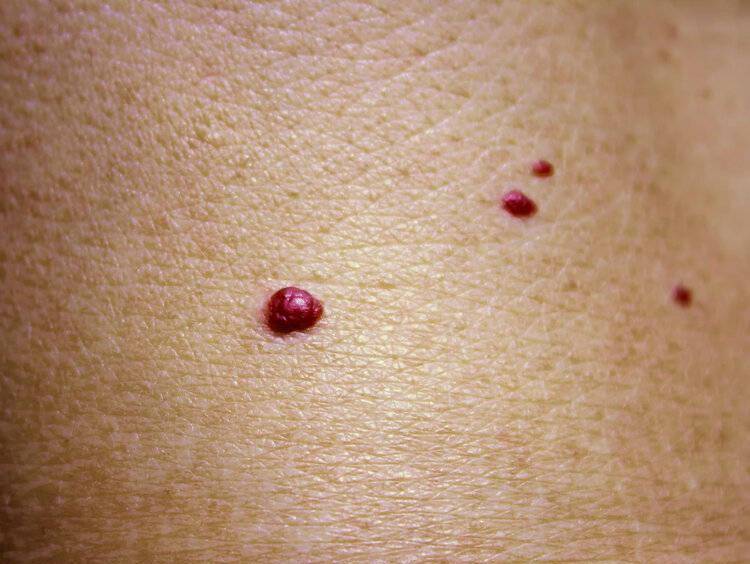 瘢痕疙瘩烫伤,划伤等因素会皮肤造成破损,甚至会留下疤痕