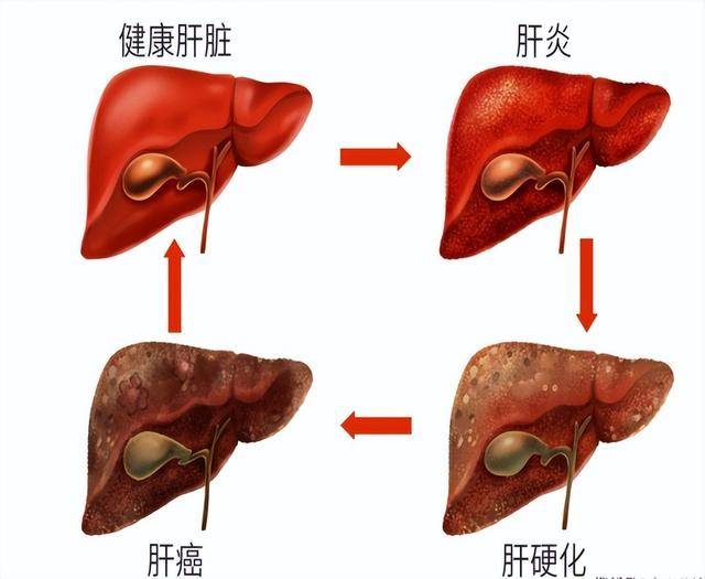 男子确诊为肝癌，与2个行为有关，身体给过信号却没留意