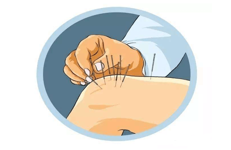 治疗老年性膝关节炎的中医方法有针刺,艾灸,拔罐,推拿,药物湿敷等.