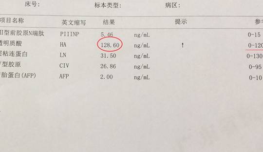 但是,肝纤维化检查并不是特异性检查,其中的四项指标,或在其他病情中
