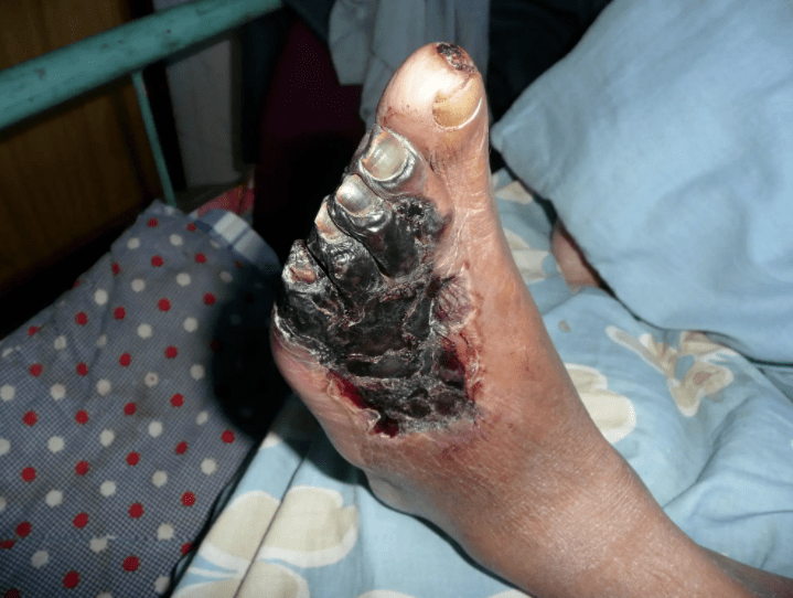 当今糖尿病的认知疏漏:"糖尿病不仅是糖多了,更关键是糖少了"