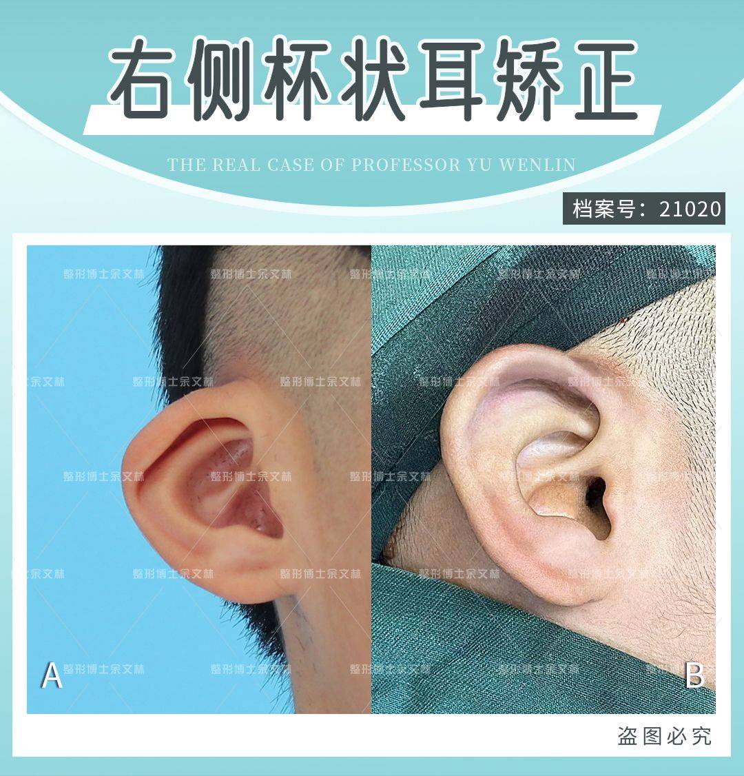 案例分析小男孩左耳招风右耳杯状耳不过家长只想矫正杯状耳