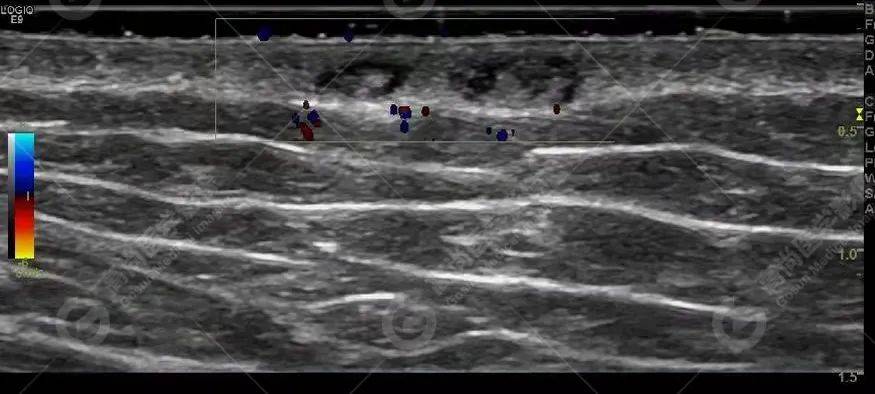 高尚超声神经纤维瘤病1例