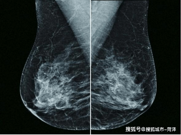 乳腺钼靶检查报告图片