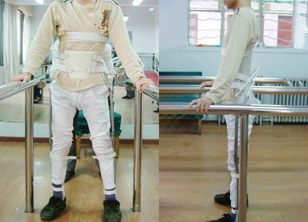 关于颈胸损伤与矫形器