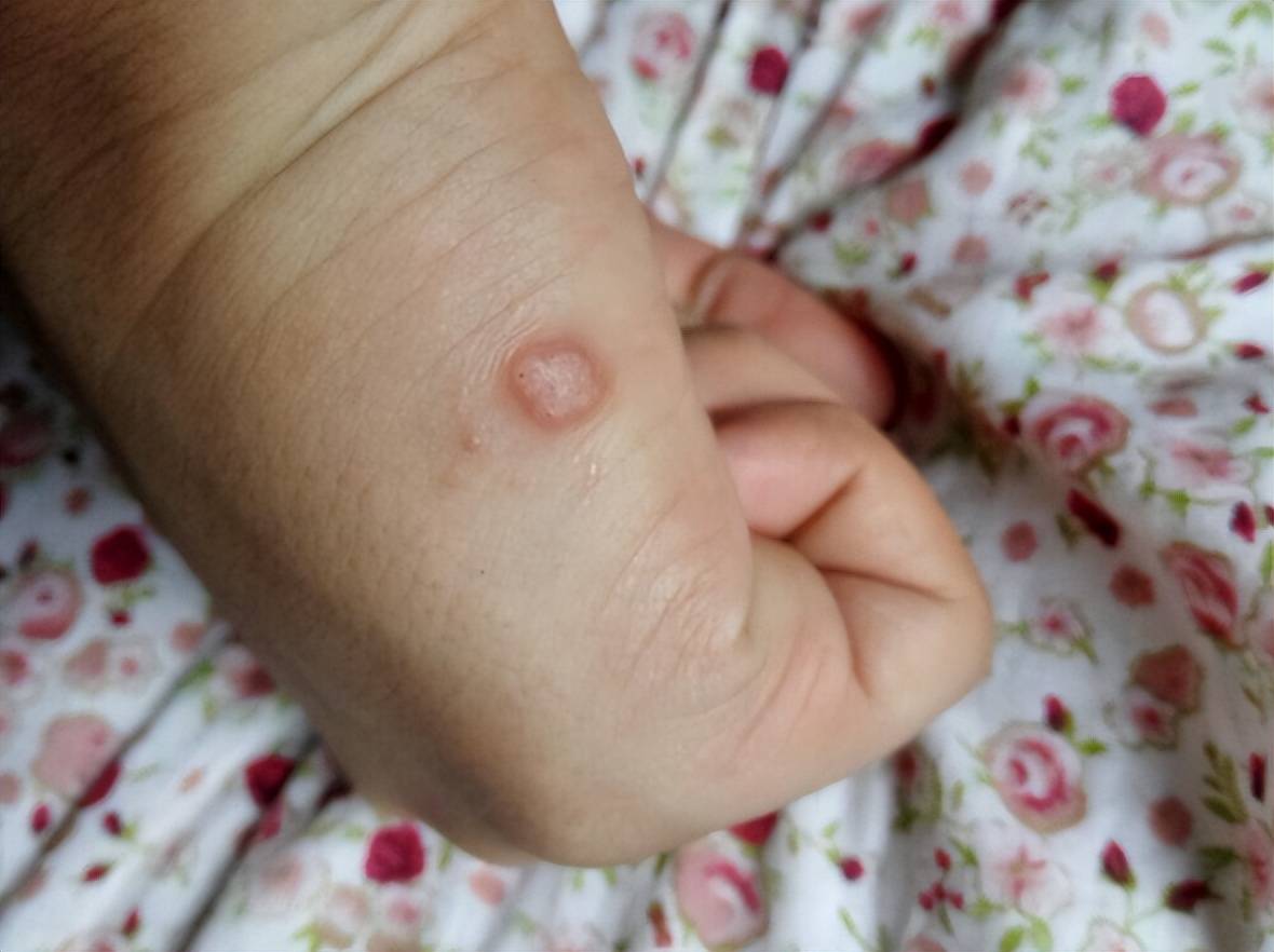 身上若2处长出小肉粒很可能是hpv来扰千万别乱用手去抠