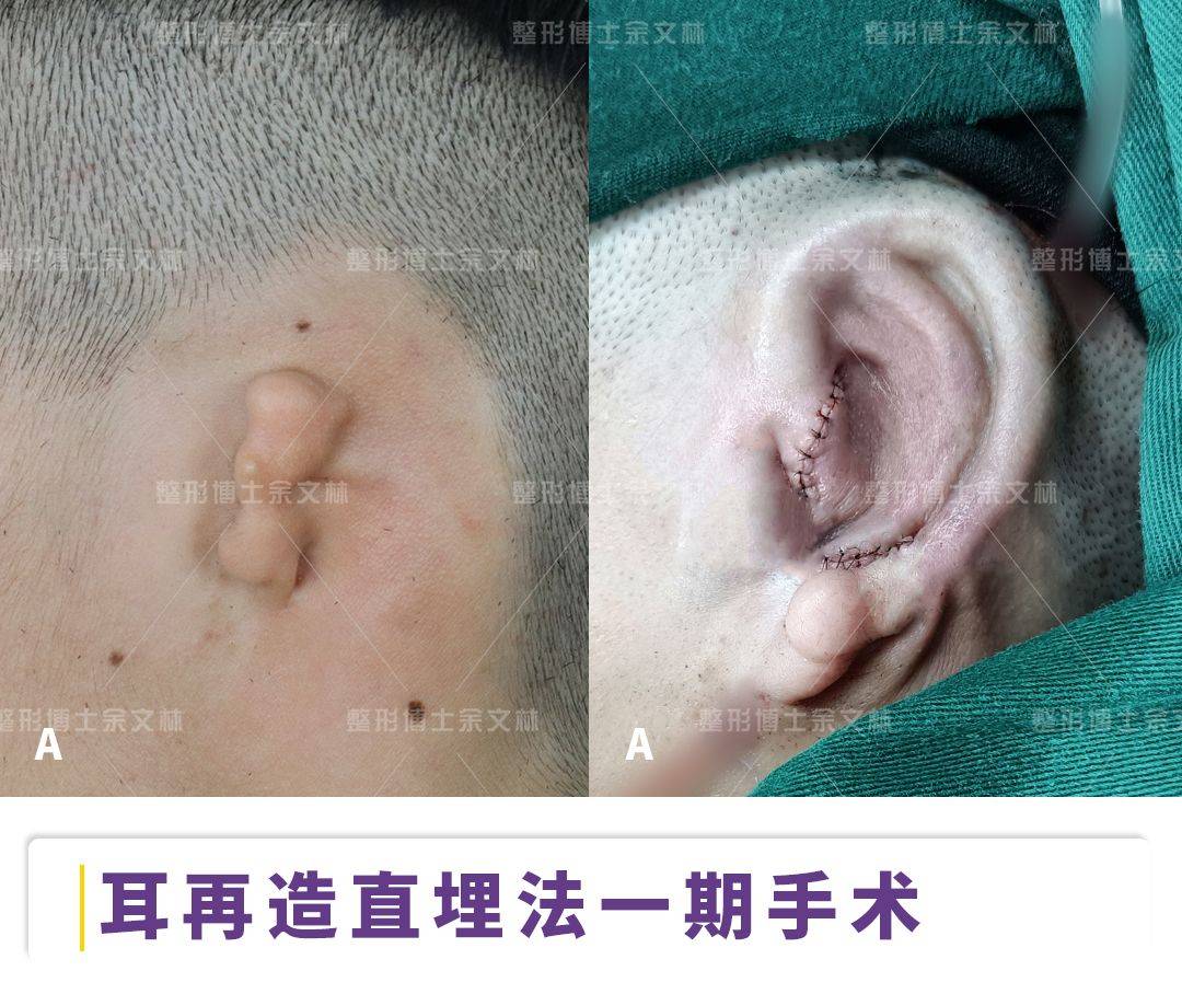 后11个月耳朵形态良好,沟壑纵横,对耳轮,对耳轮脚等细微结构清晰,耳舟