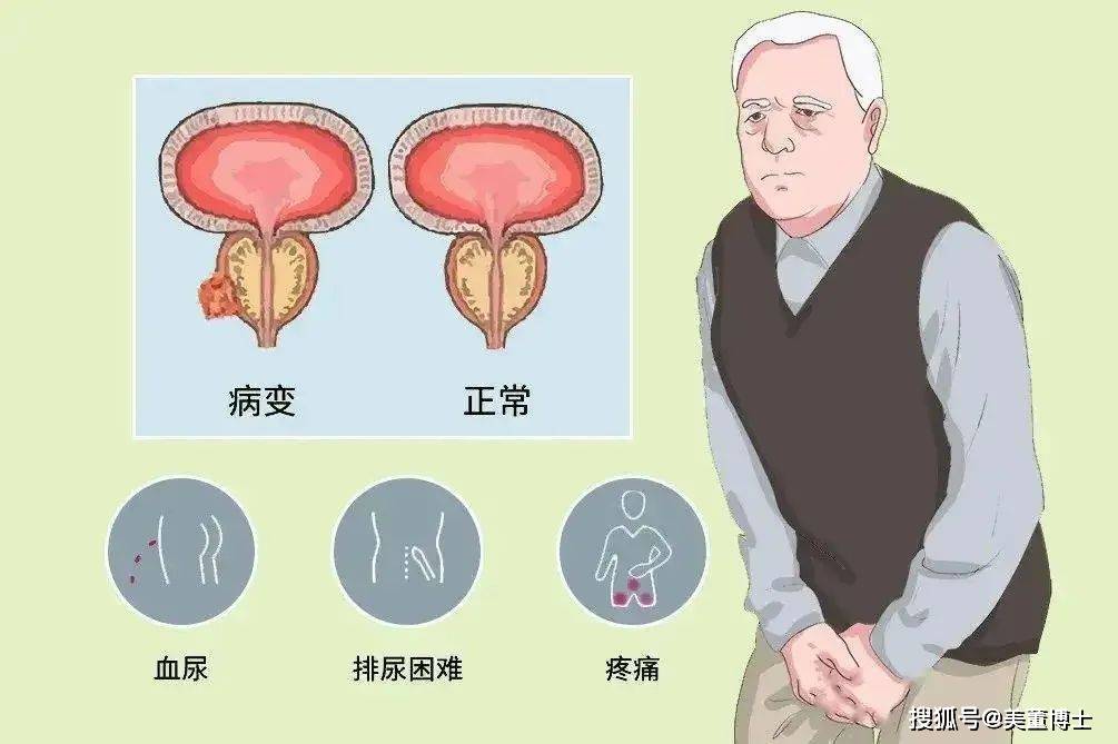 前列腺_男性_患者