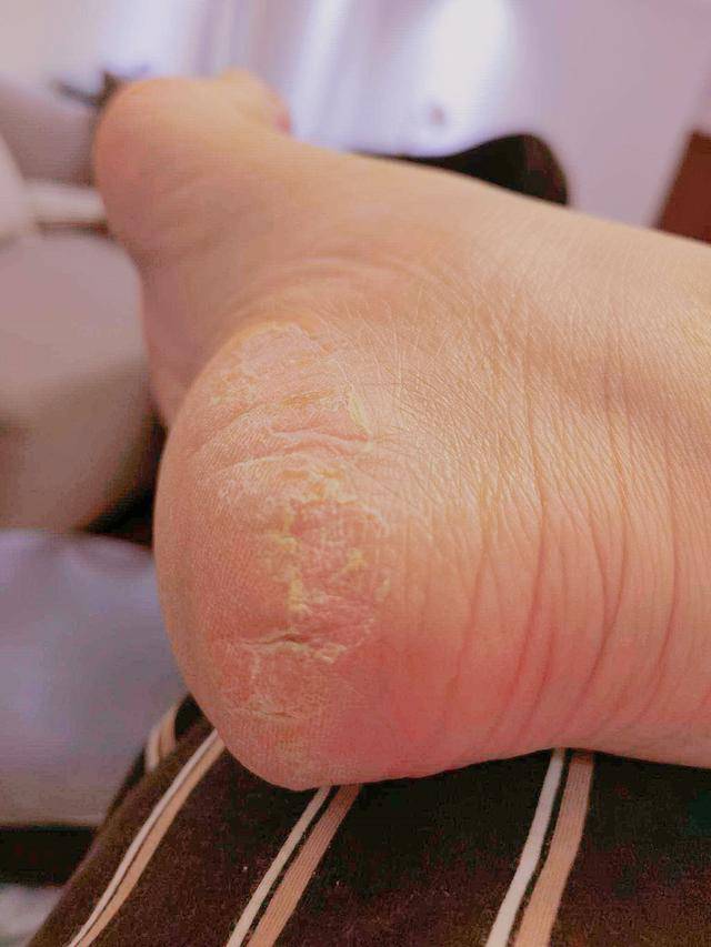 皮肤性病科门诊目前图片显示,脚后跟皮肤出现起硬皮,裂口,考虑是皲裂