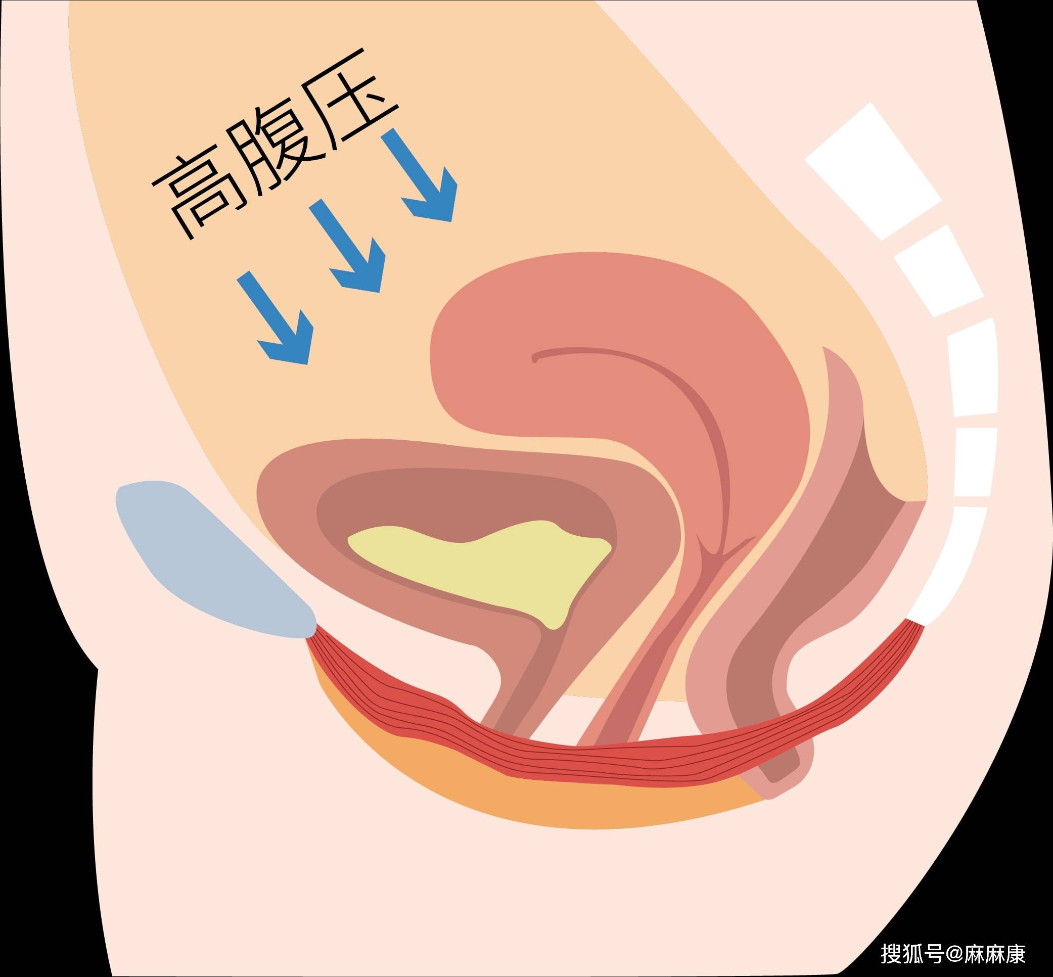 原創為什麼你做凱格爾運動沒效果這5個原因通常被忽略掉了