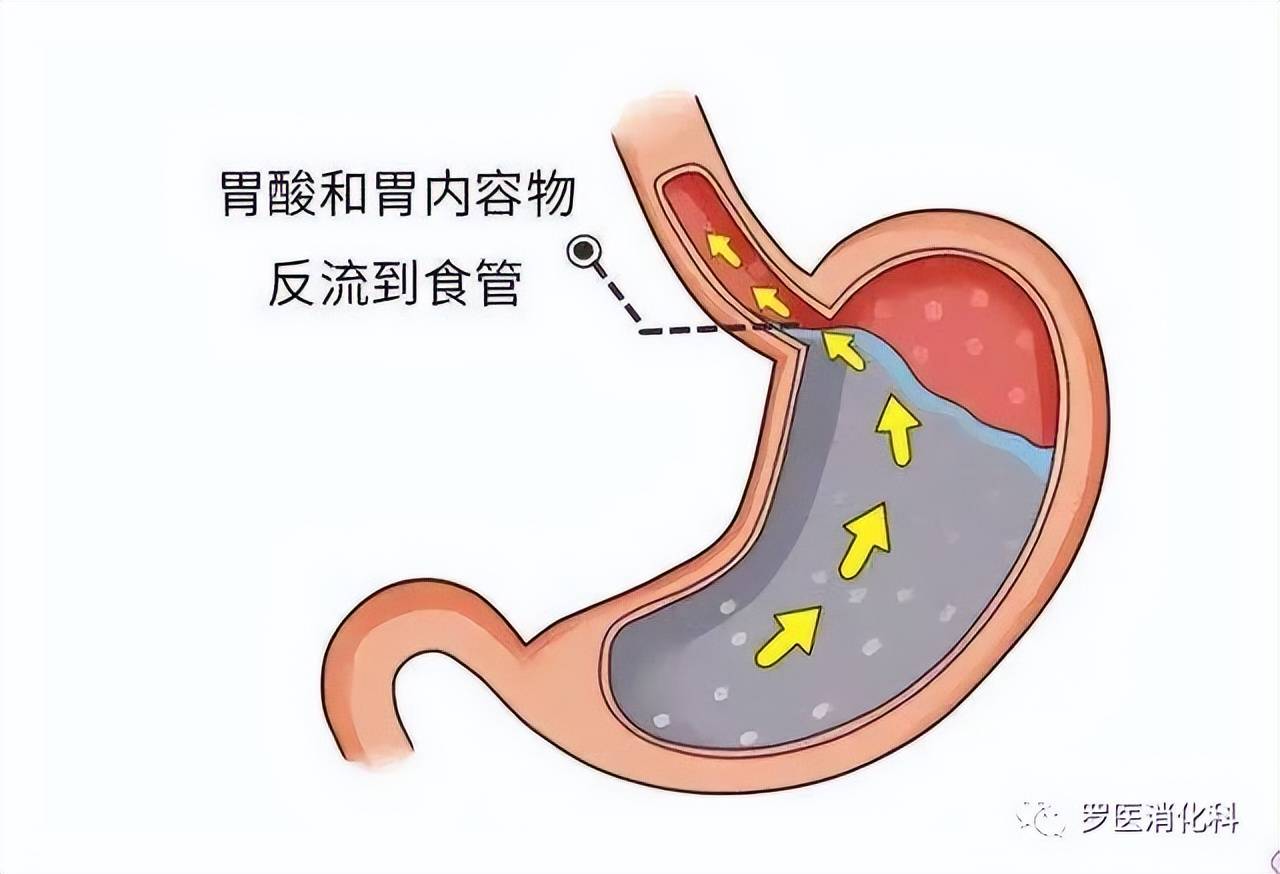 食物反流燒心咋回事可能是胃食管反流病