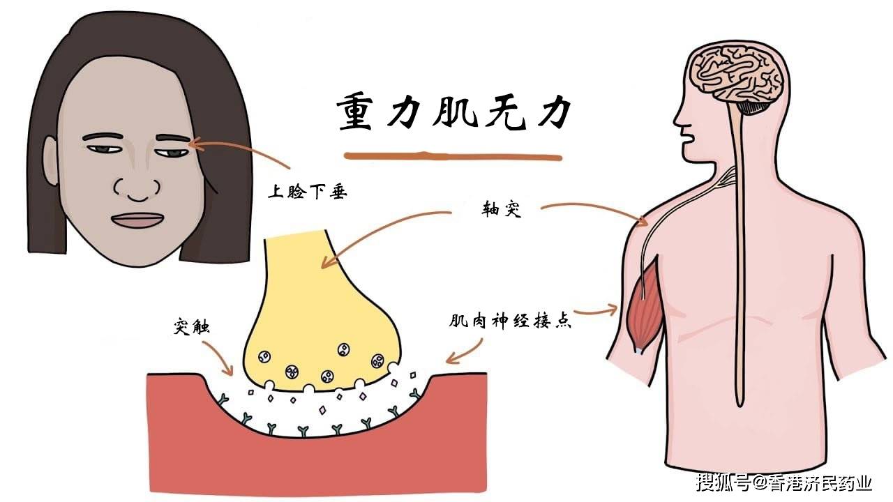 首個全身性重症肌無力長效c5補體抑制劑ultomiris於fda獲批