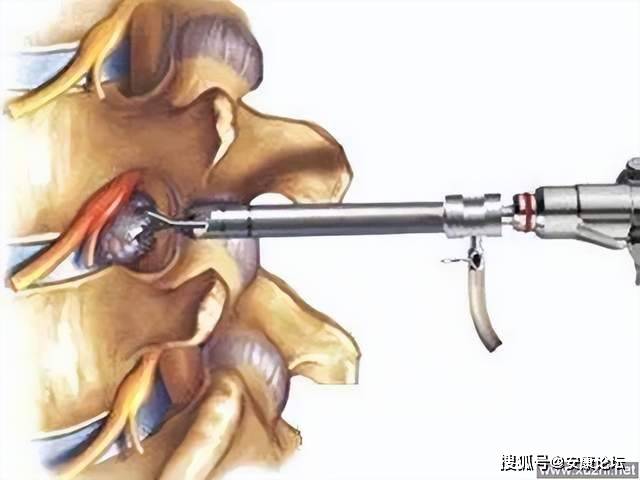 椎间孔镜手术微创治疗颈,腰椎间盘突出症_脊柱_神经_孔入路
