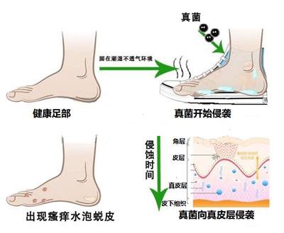 原创
别再用白醋大蒜治脚气了,后果很严重!看看正确的脚气治疗姿势是什么?