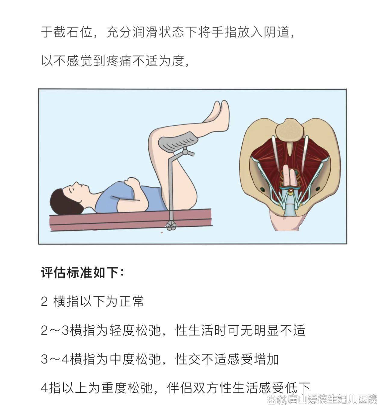 宫颈口松弛锻炼图片图片