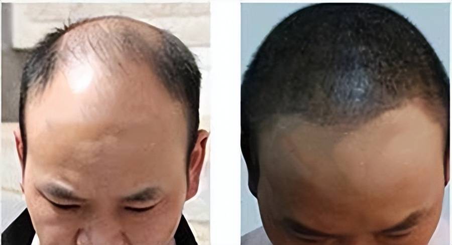 头发是否可种植种植头发需要多少钱一根是不是很贵