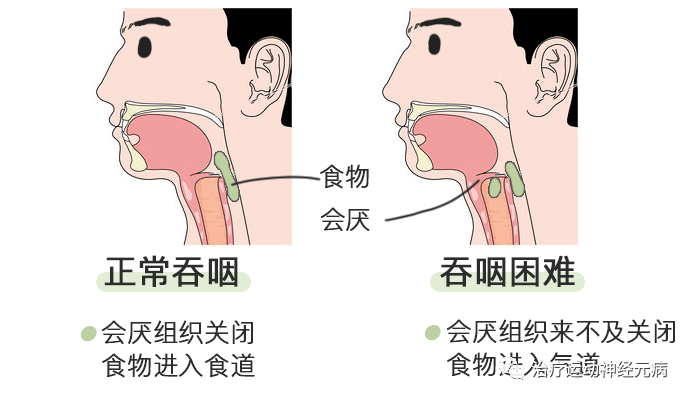 语言不清吞咽困难进行性延髓麻痹这样治疗喜获良效