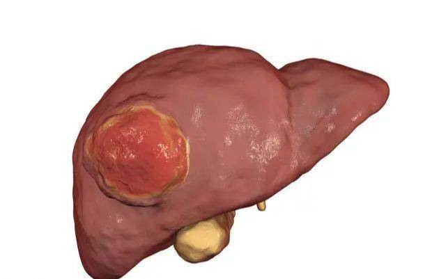 早期肝癌症状图片