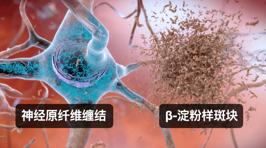 研究发现,患者脑部有两种典型的病理:β-淀粉样斑块和神经原纤维缠结