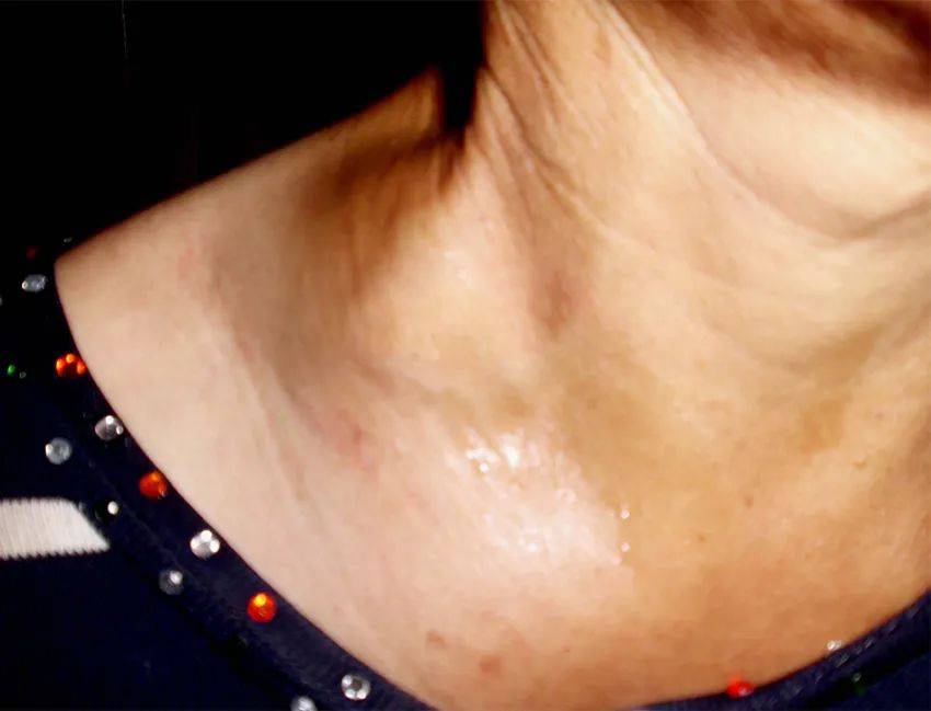 但是三年前吴阿姨突然出现间歇性声音沙哑的症状,伴随的是右边锁骨