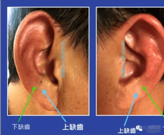 运用耳廓诊病耳诊高清耳图