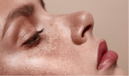 脸色暗沉有色斑,教你一个小妙招,美白又嫩肤!_祛斑_激光_皮肤