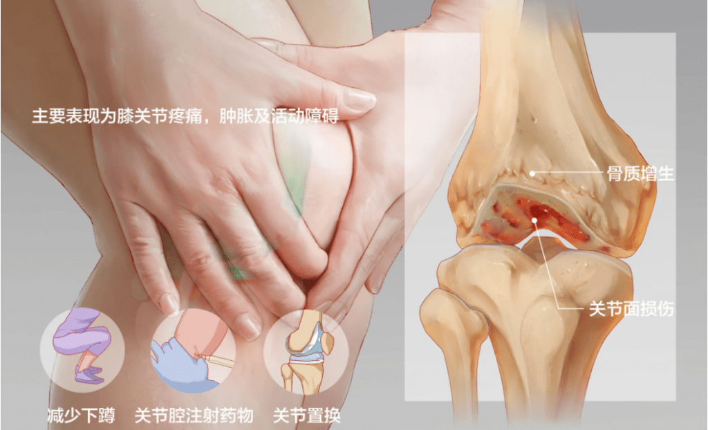 患者_关节炎_症状