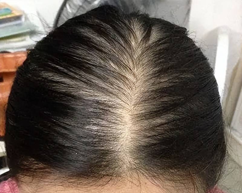 告别秃顶毛发种植管用吗天生头发少能植发吗瞧瞧