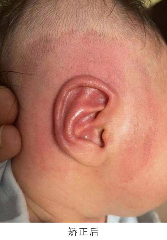 新生儿耳廓压扁图片图片