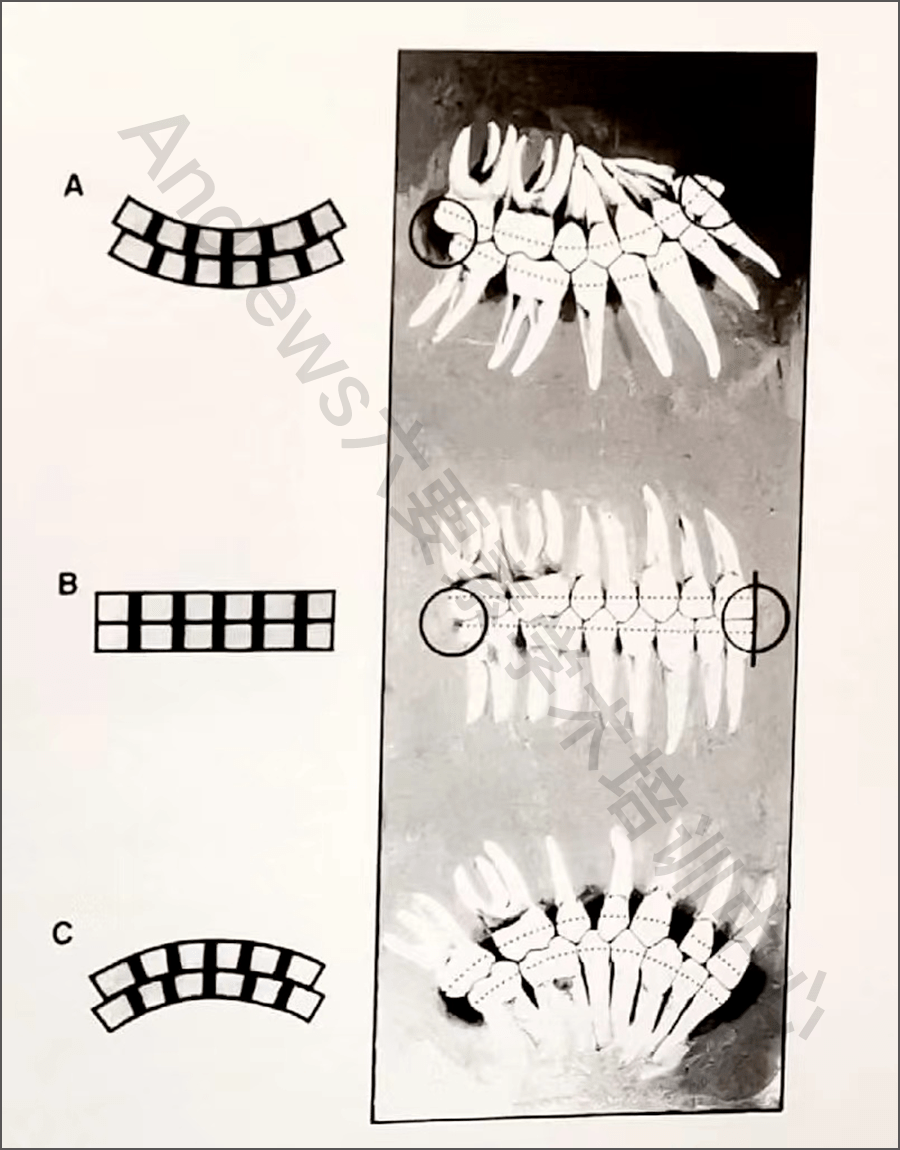 spee曲线:spee曲线平坦或有轻微的曲度.
