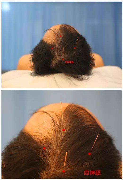 镇静安神针法治疗失眠