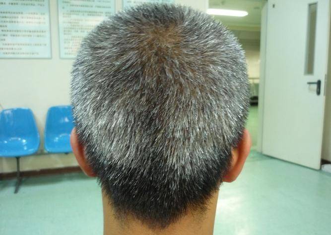 原创
为何越来越多的人未老先白发，白发还有恢复乌黑亮丽的可能吗？