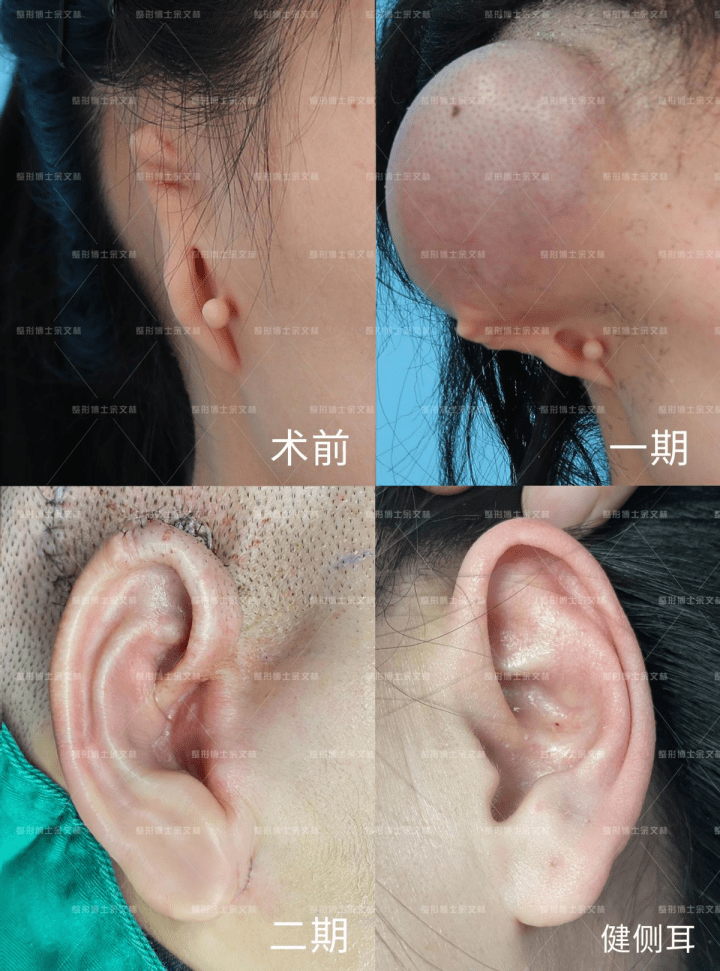 小耳畸形怎么办 小耳畸形怎么矫正 扩张 再造术 手术