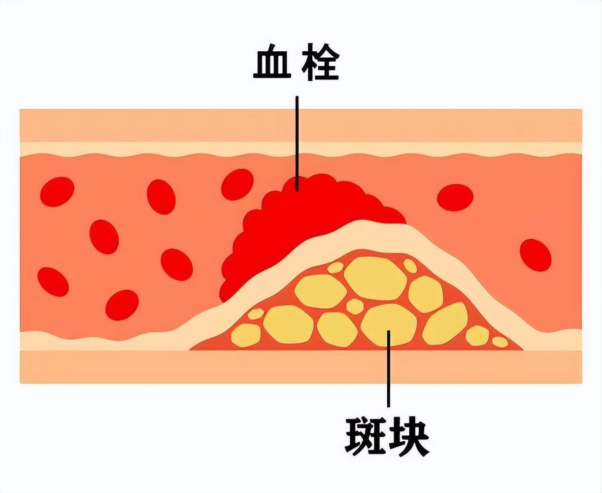 血栓和斑块的区别图片