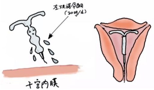 医德佳腺肌症保宫你了解曼月乐环吗