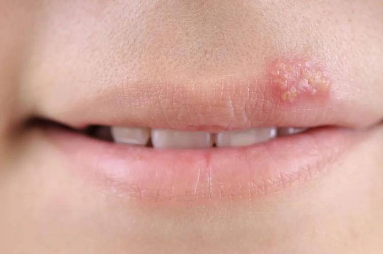 一旦感染终身携带嘴唇经常起泡可能是这种病毒在作怪