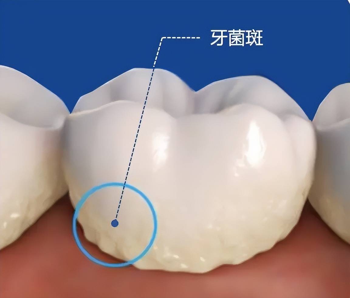 冲牙器的危害和好处科普警惕这些禁忌