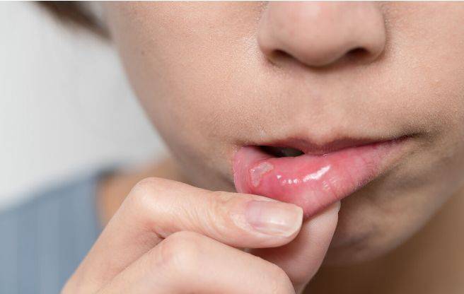 口腔溃疡易发生在舌腹,软腭区和悬雍垂.