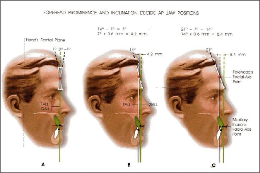 额头形状与侧貌美观有何关系?_andrews_前额_患者