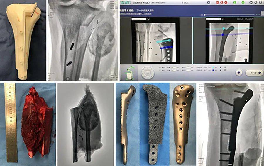 玖兆family优秀病例展天玑辅助导航定位下骨肉瘤的保肢治疗