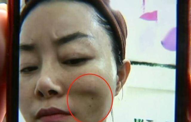 那些体验过"美容针"的女人,现在怎么样了,听听她们怎么说_效果_皮肤