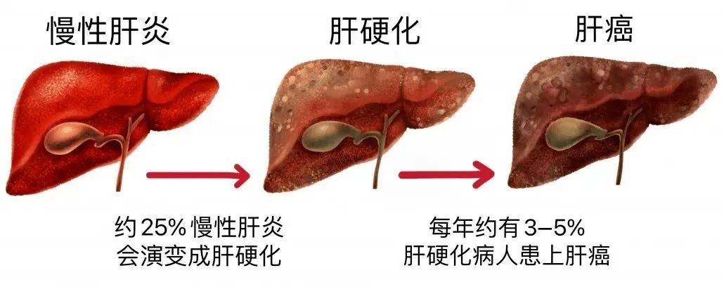 肝硬化是肝癌的最后一道防线肝硬化癌变三大信号要重视