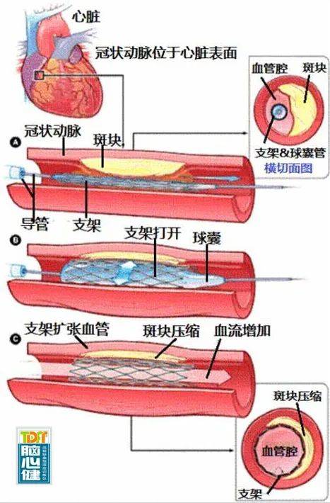血管支架寿命图片