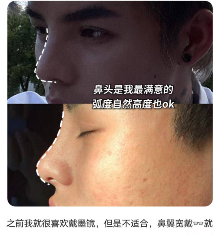 原创殷世航大方晒出自己整容过程看清他以往颜值后他整容是正确的
